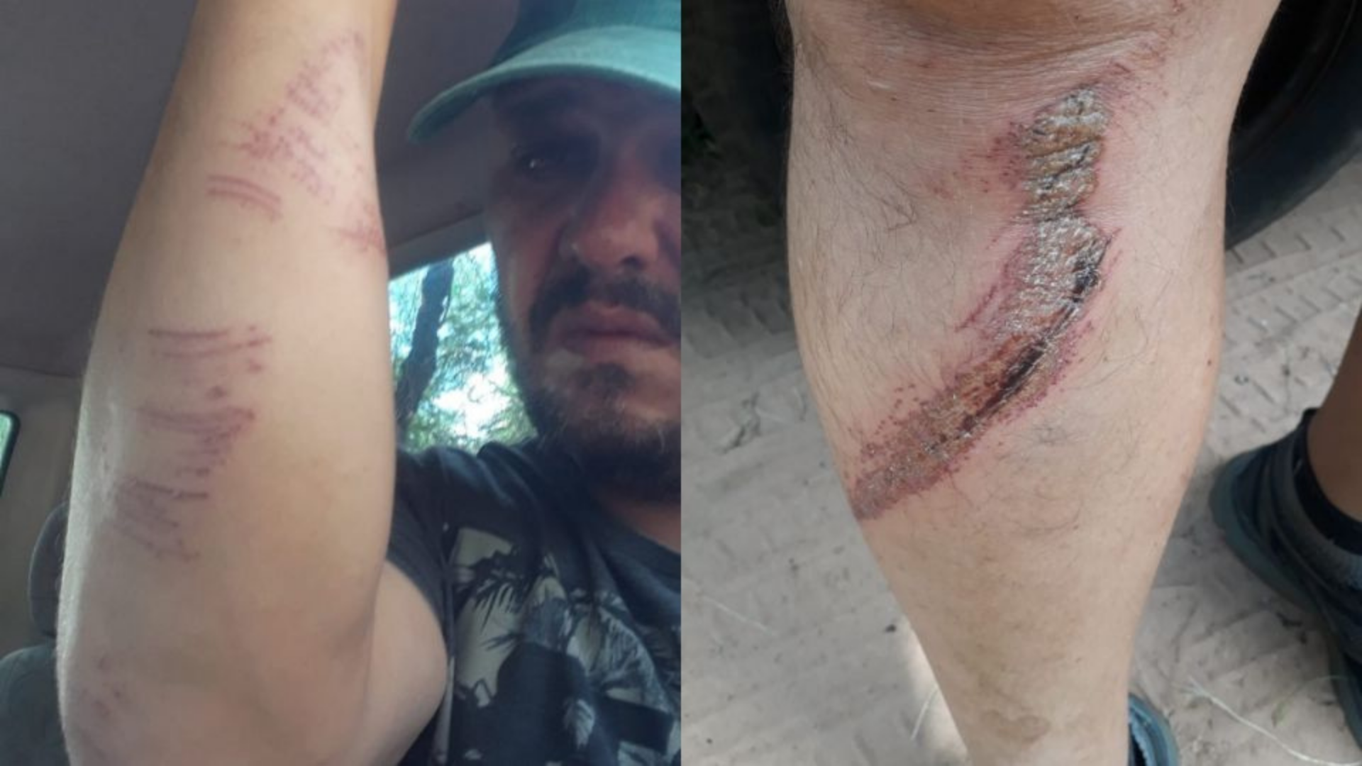 Com camisa de Lula, homem é espancado por bolsonaristas. Foto de hematomas no braço e na perna do homem agredido.