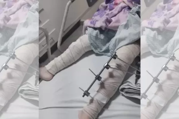 Equipe médica se confunde e opera perna errada de menina de 6 anos