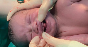Mãos de médico com luvas, abrindo boca de bebê que nasceu com dentes