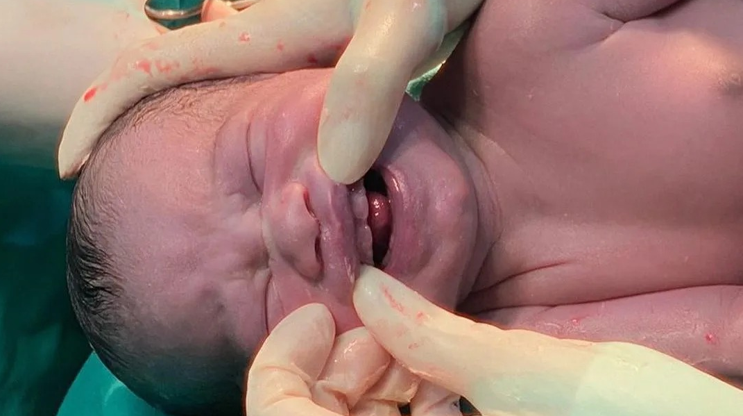 Mãos de médico com luvas, abrindo boca de bebê que nasceu com dentes