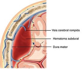 Ilustração sobre hematoma subdural