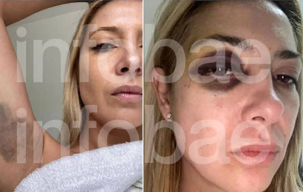 Montagem de duas fotos de Fabíola Yañez com hematomas