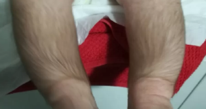 Pernas de criança com hipertricose