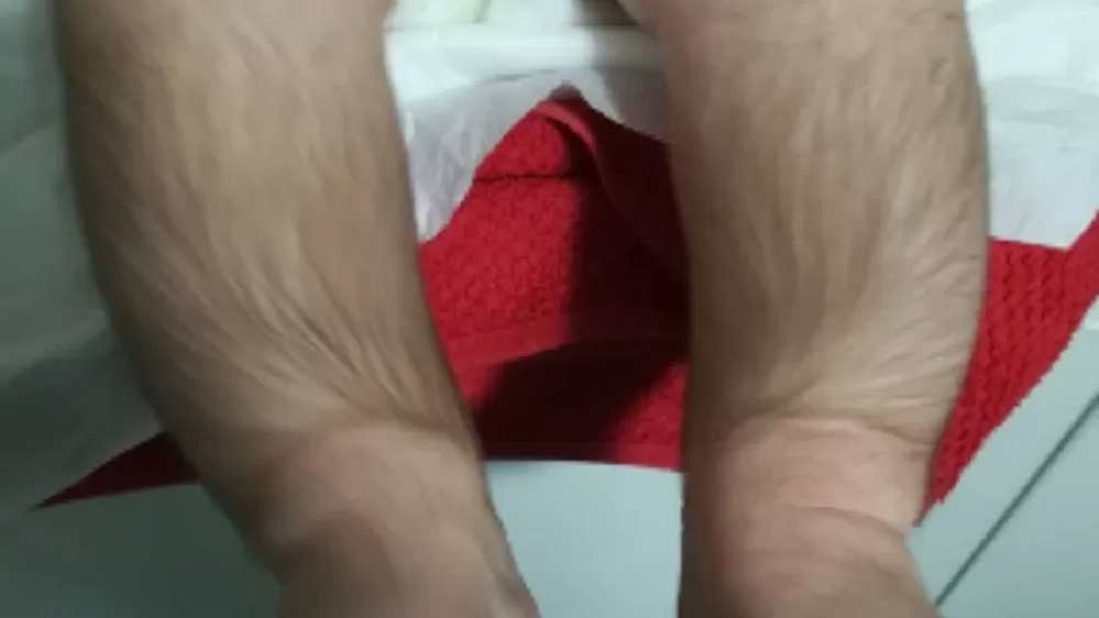 Pernas de criança com hipertricose