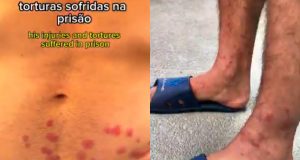 Montagem de duas fotos de lesões no corpo de Thiago Ávila, ativista da Flotilha da Liberdade