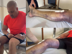 Montagem de fotos de ex-deputado Daniel Silveira com perna roxa