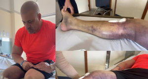 Montagem de fotos de ex-deputado Daniel Silveira com perna roxa