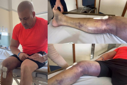 Montagem de fotos de ex-deputado Daniel Silveira com perna roxa