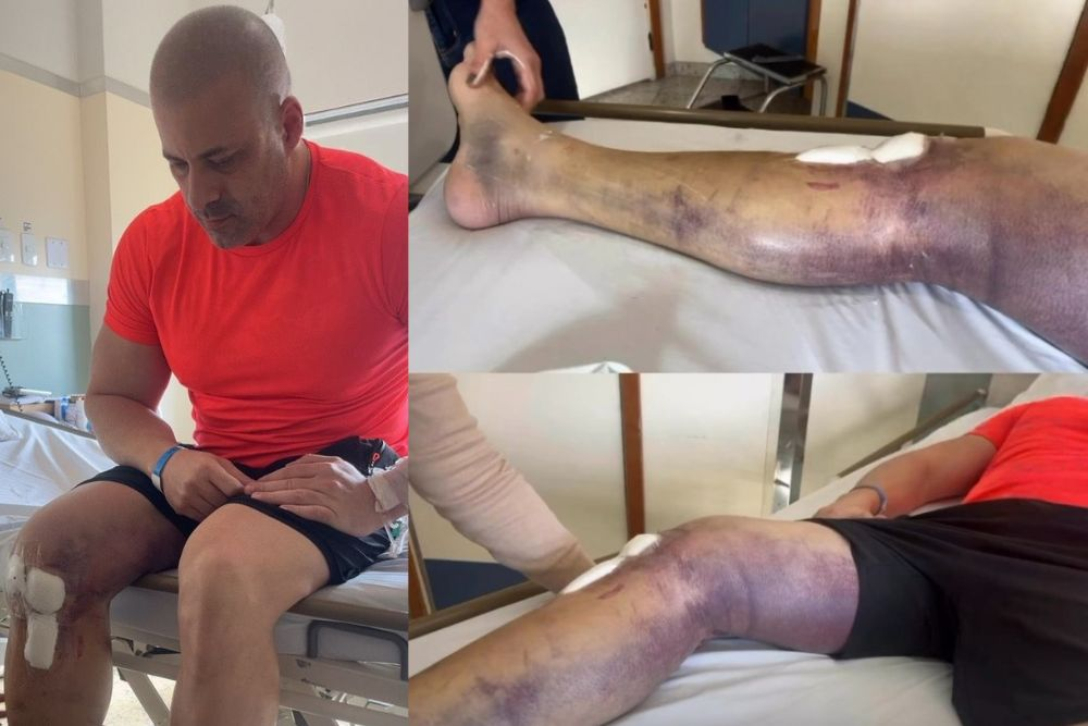 Montagem de fotos de ex-deputado Daniel Silveira com perna roxa