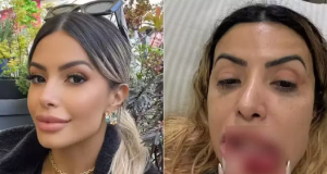 A influenciadora Janaína Prazeres antes e depois de agressão em duas fotos