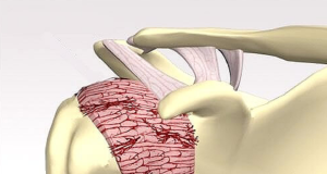 Ilustração sobre ombro congelado