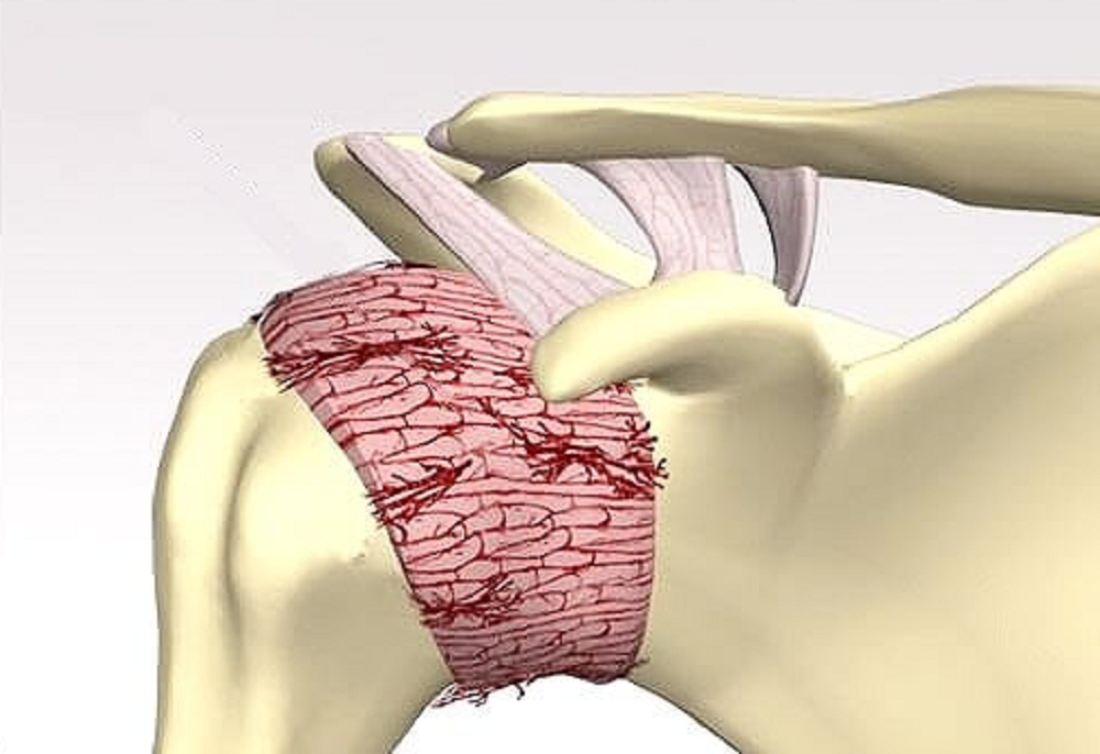 Ilustração sobre ombro congelado