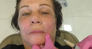 Silvana de Bruno, de 66 anos, fazendo procedimento estético, séria, olhando para a câmera, em close