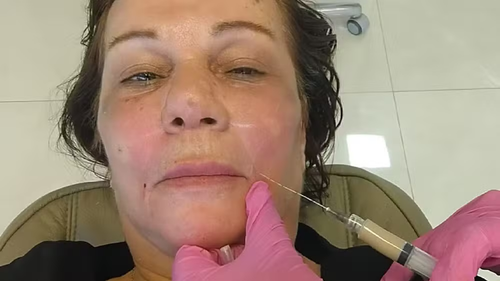 Silvana de Bruno, de 66 anos, fazendo procedimento estético, séria, olhando para a câmera, em close