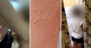 Montagem de três fotos de Marcas das agressões pelo corpo de adolescente