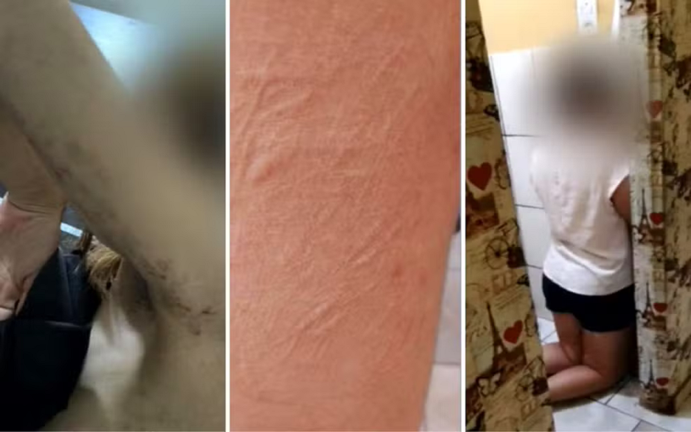 Montagem de três fotos de Marcas das agressões pelo corpo de adolescente