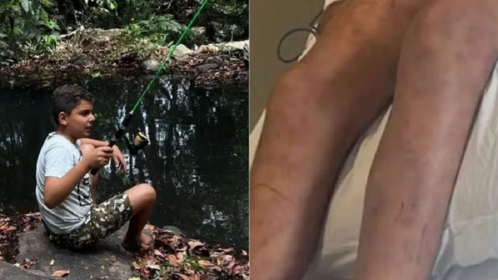 Montagem de fotos de João Pedro sentado e de pernas picadas por abelhas