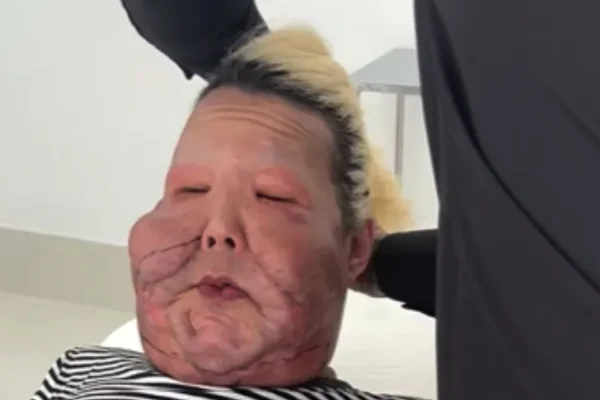 VÍDEO - Juju do Pix mostra como ficou o rosto após retirar óleo mineral