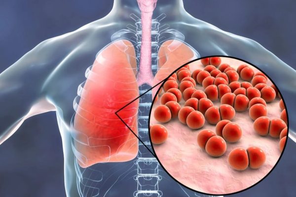 Entenda o que é broncopneumonia, a doença que levou Bolsonaro à UTI