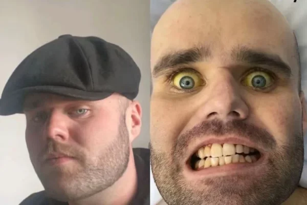 Beijou a morte? Jovem fica com a pele amarelada após vício em vodca no café da manhã