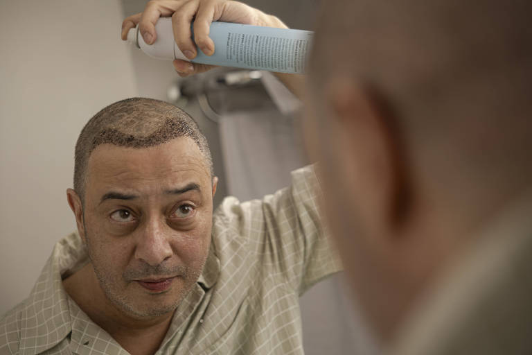 O repórter da Folha Ivan Finotti, disse ter sentido uma dor intensa em anestesia para seu transplante capilar.