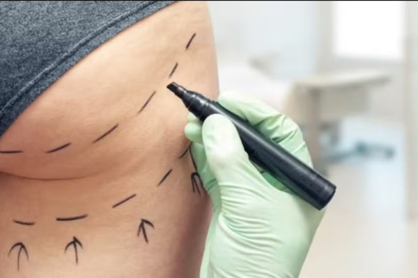 Moda do “bumbum grande” avança mesmo com alto risco de morte