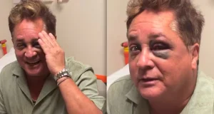 Leonardo caiu em pescaria e ficou com o olho roxo.