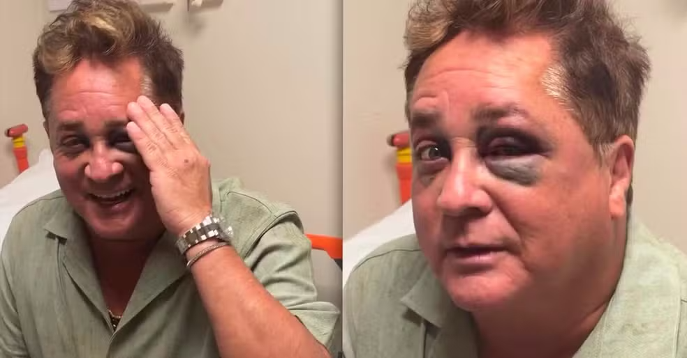 Leonardo caiu em pescaria e ficou com o olho roxo.