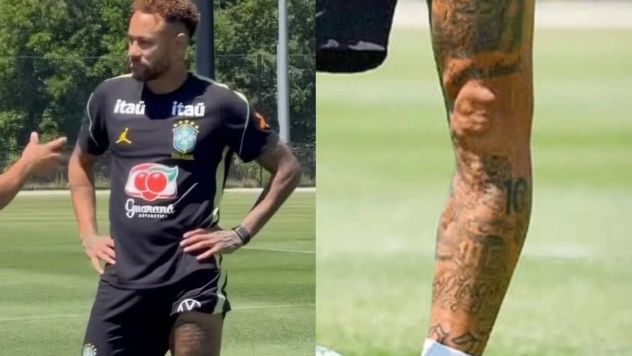Perna de Neymar com hematomas, cicatrizes e curvatura no joelho