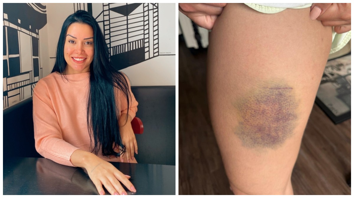 Jéssica Soares com ferimentos pelo corpo após luta corporal
