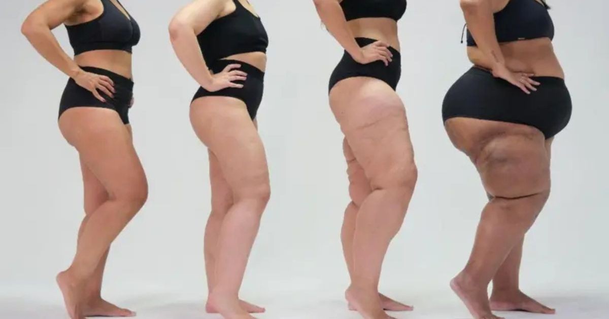 Pernas de mulher relacionadas ao lipedema