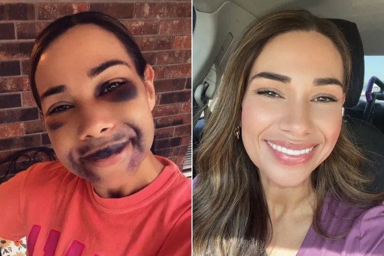 Lacey Duvall durante a recuperação dos implantes dentários e com o sorriso após o tratamento