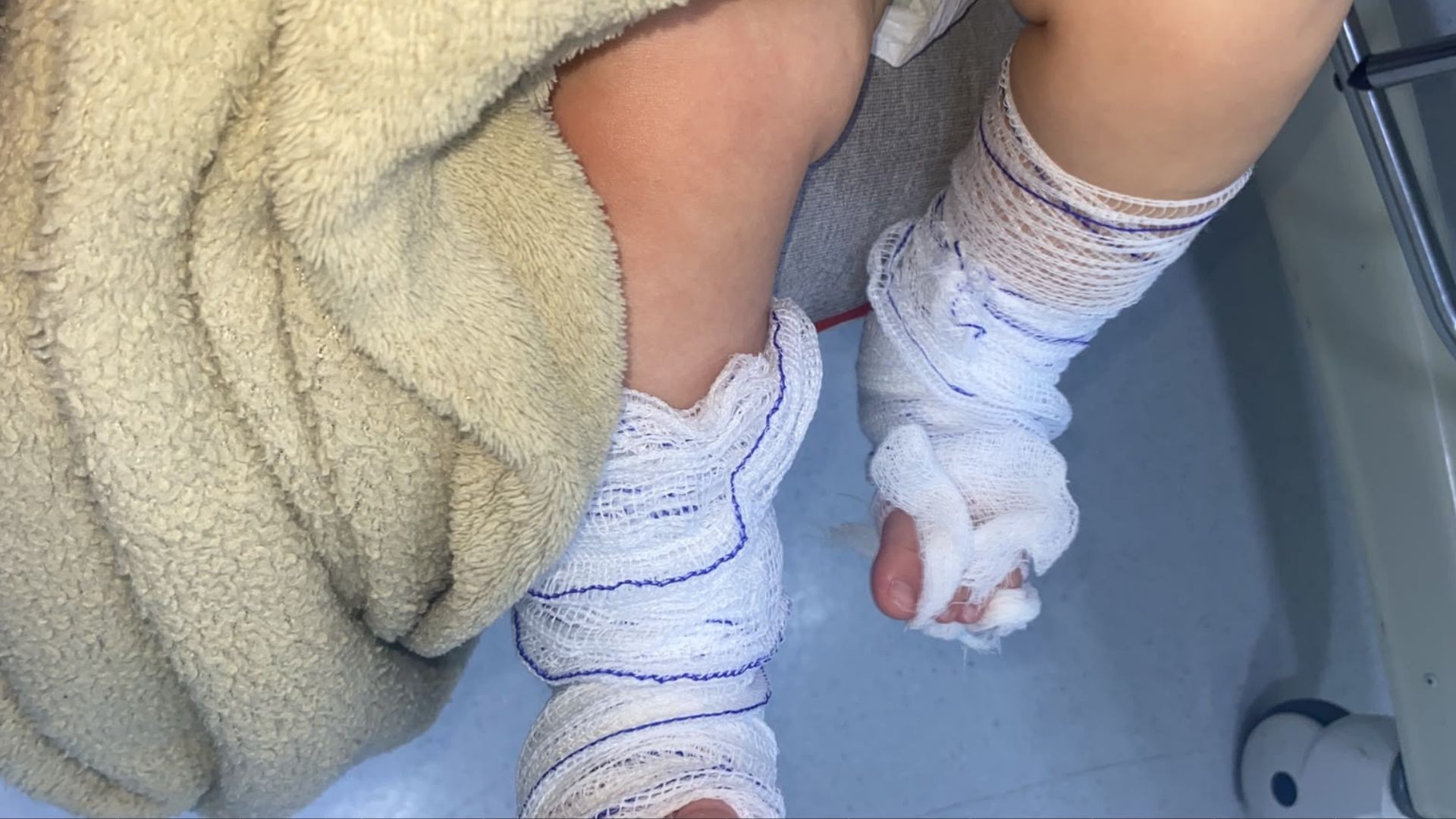 Bebê de 11 meses que sofreu queimaduras em escola no RS