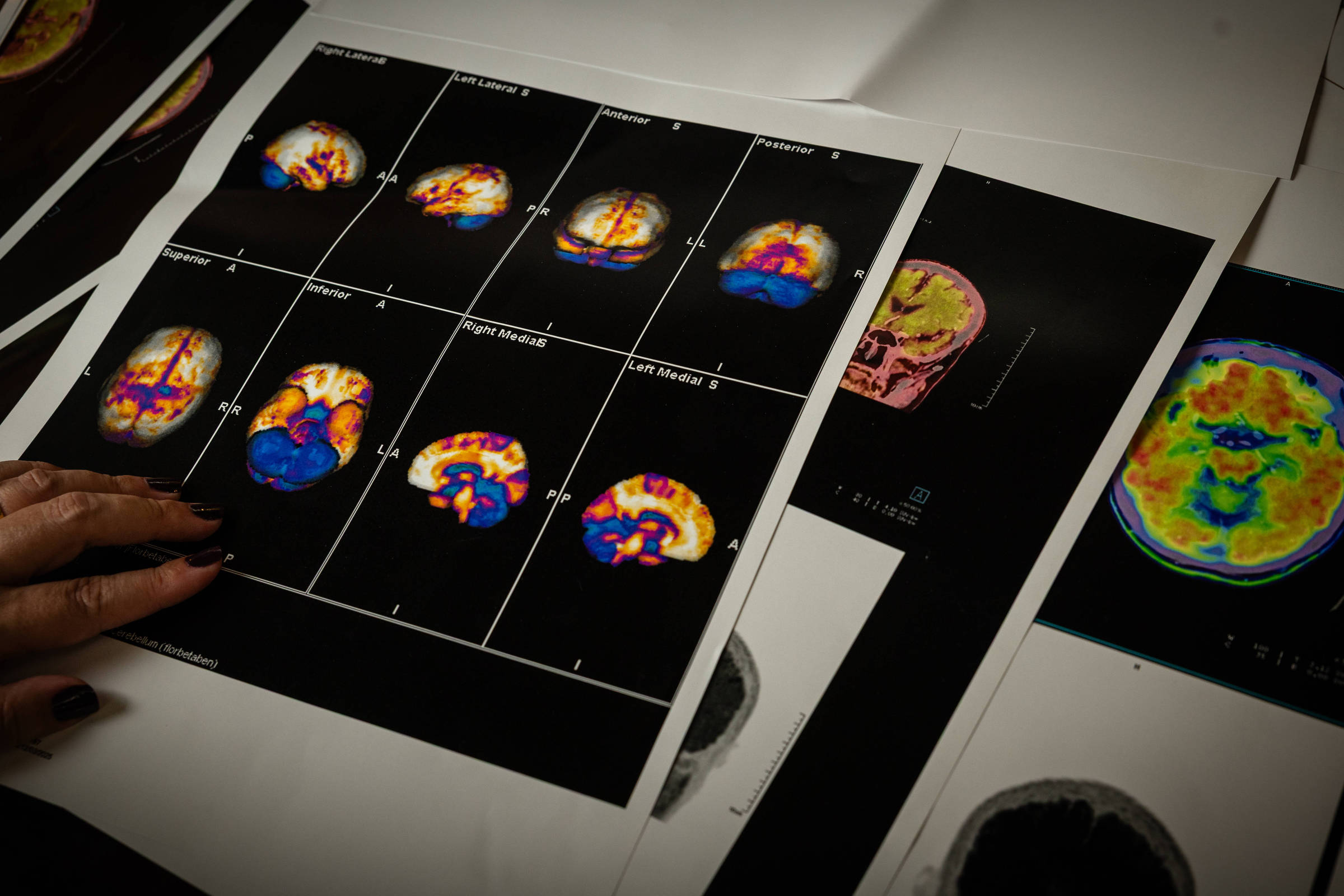 Exames cerebrais de paciente com diagnóstico de Alzheimer
