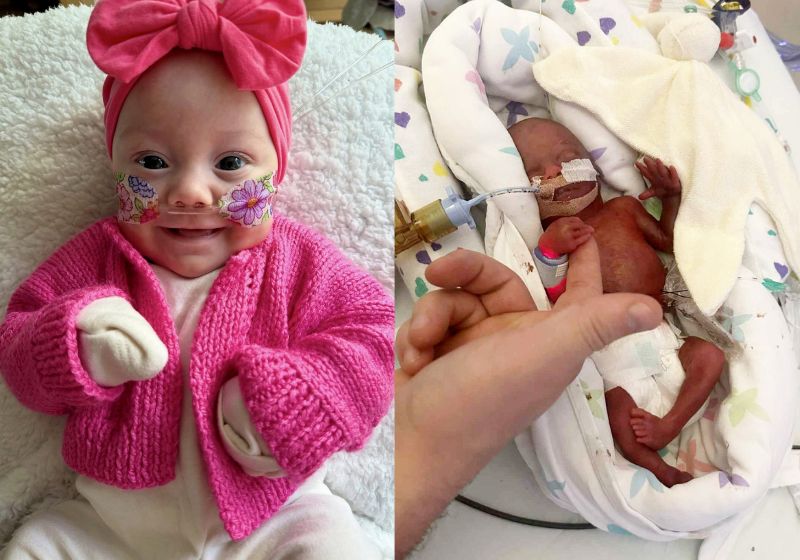 Bebê Hope durante internação neonatal