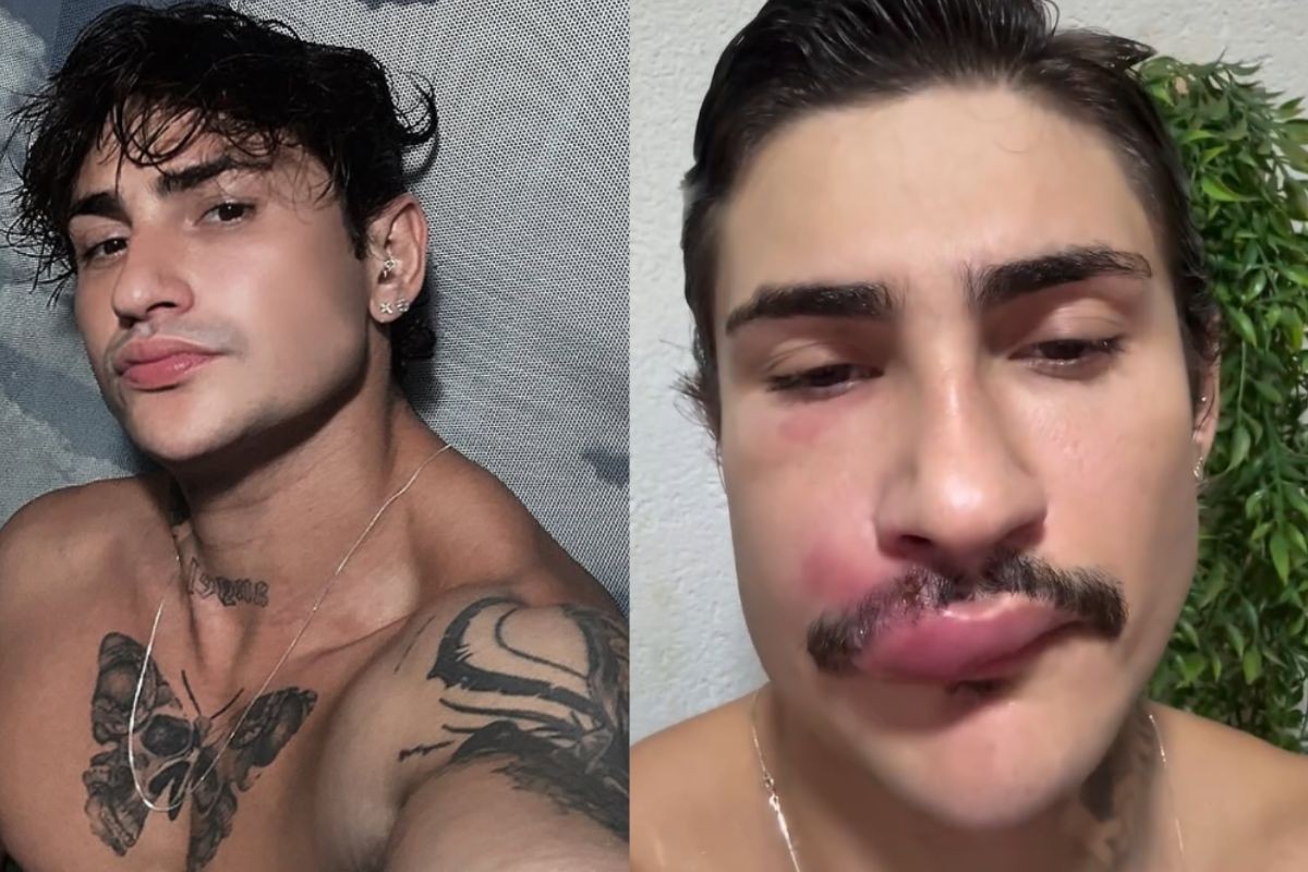 Influenciador Ken de CG com inchaço no rosto