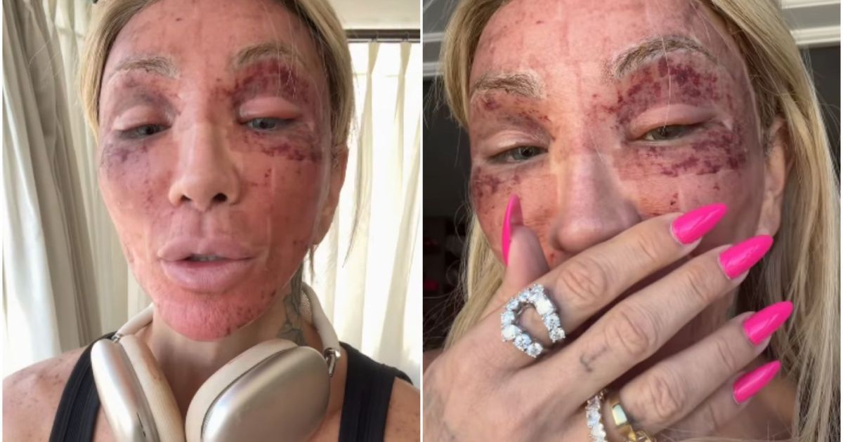 Maya Massafera com o rosto inchado após procedimento facial
