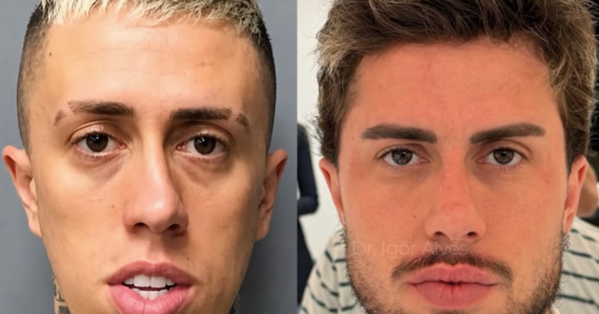 MC Daniel mostra antes e depois após procedimentos estéticos