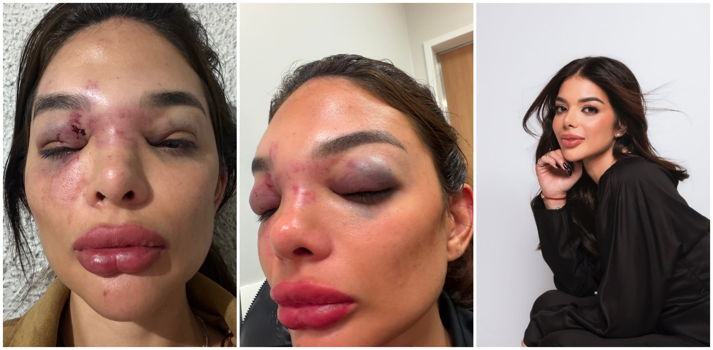 Giullia Falcão Kos com ferimentos no rosto