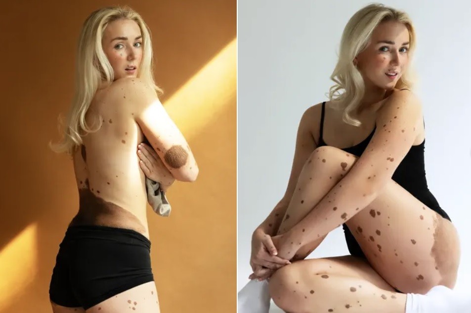 Scarlett Clarke, universitária inglesa com manchas de nascença pelo corpo