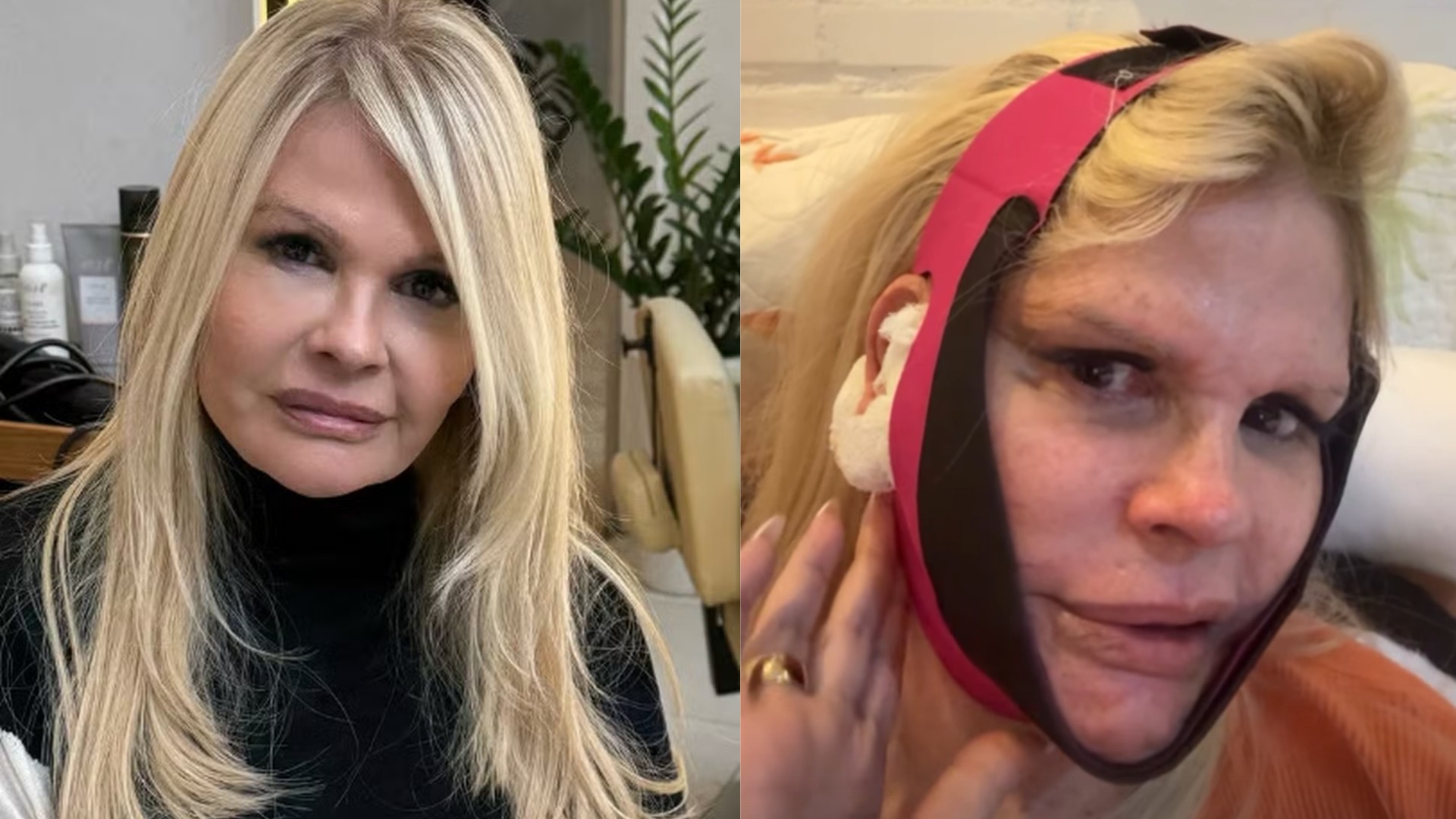 Monique Evans com faixa de compressão no rosto após minilifting facial