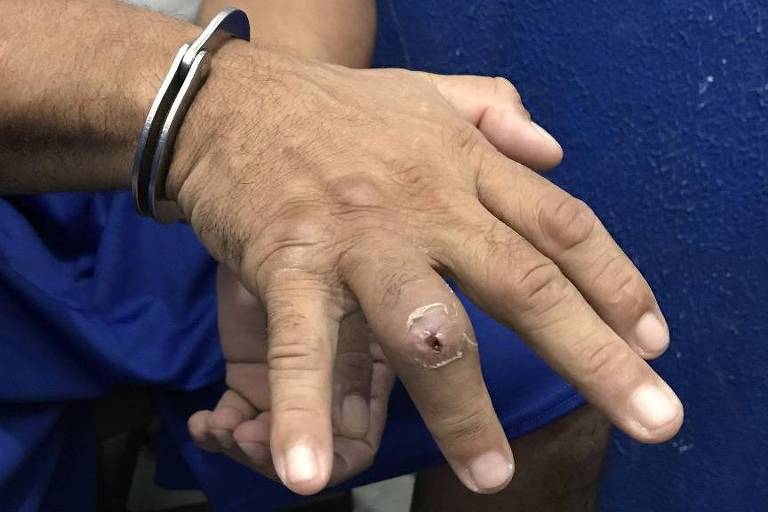 Preso com dedo ferido por golpe de cassetete