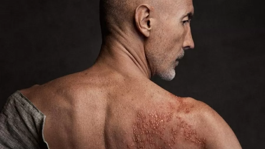 Ilustração sobre herpes-zóster