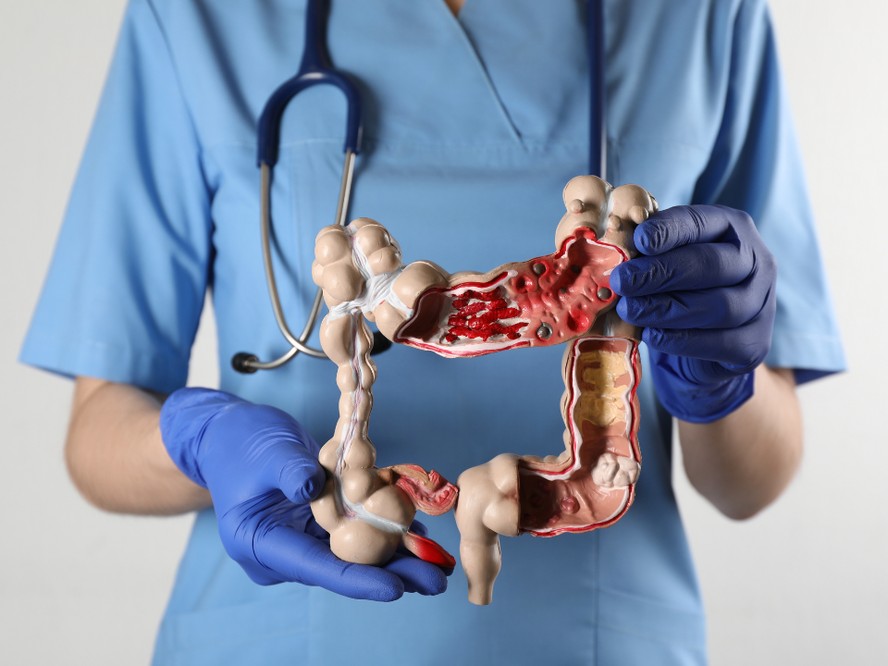 Ilustração sobre doenças inflamatórias intestinais