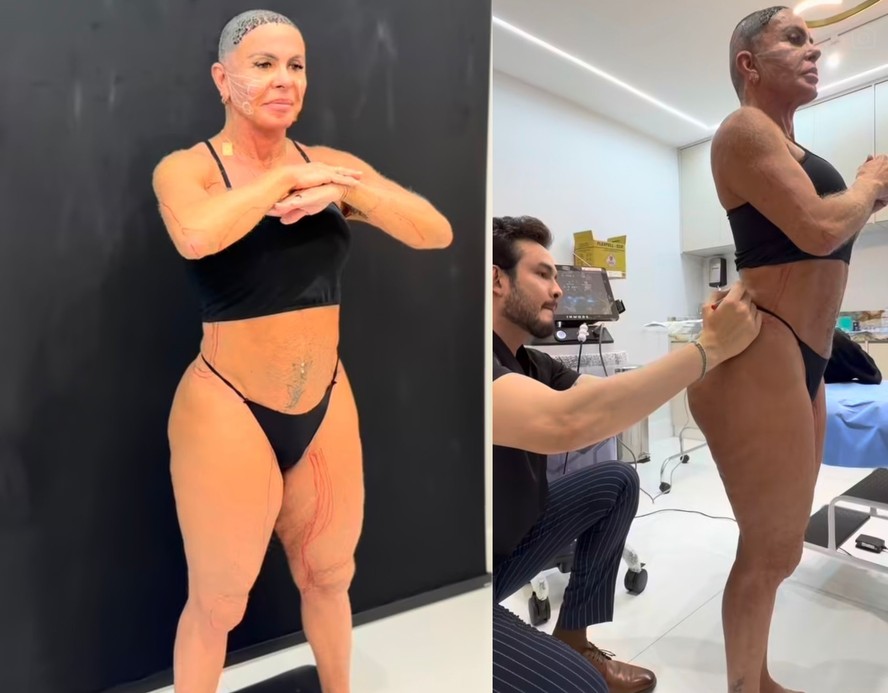 Gretchen durante tratamento estético contra flacidez