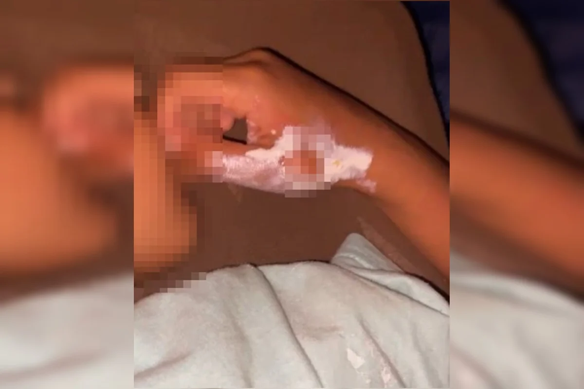 Mão de criança com bolhas causadas por queimaduras