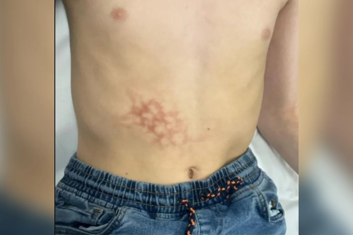 Lesão cutânea em padrão reticulado no abdômen de garoto