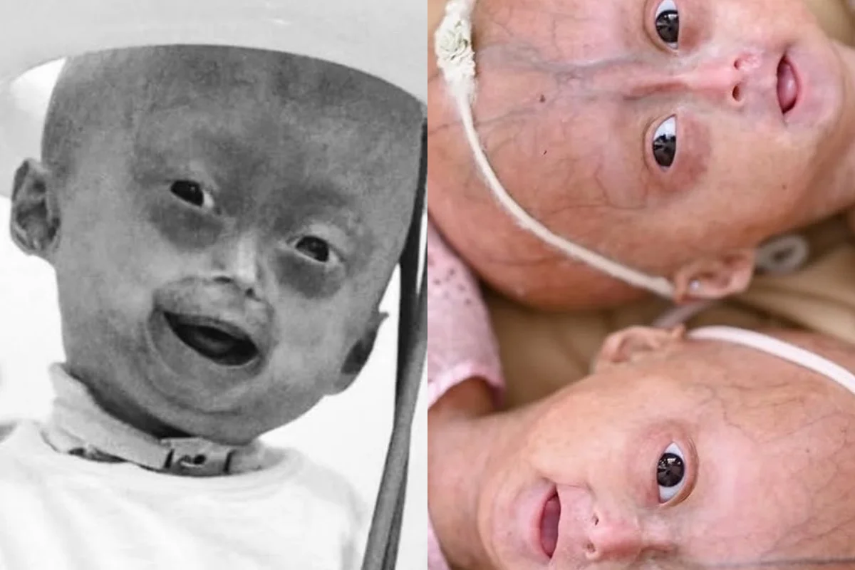 Elis Lima Carneiro, menina de 5 anos diagnosticada com progéria