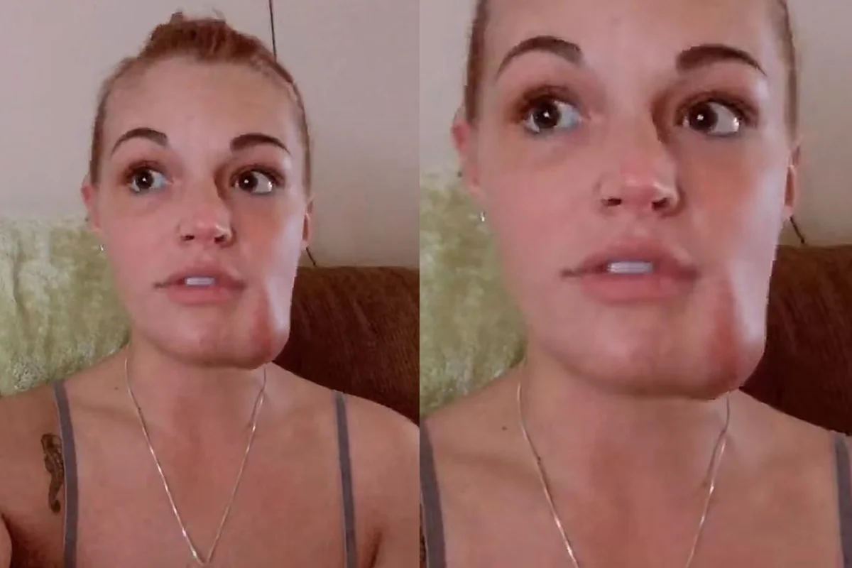 Hope Schiefer com protuberância no rosto