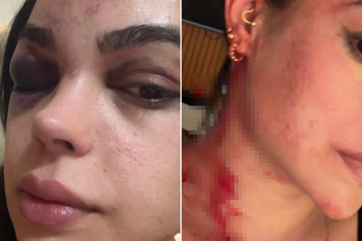 Raíla Miranda com ferimentos no rosto e na cabeça